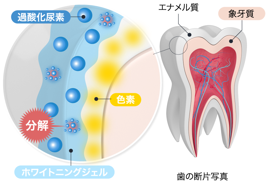 ホワイトニング