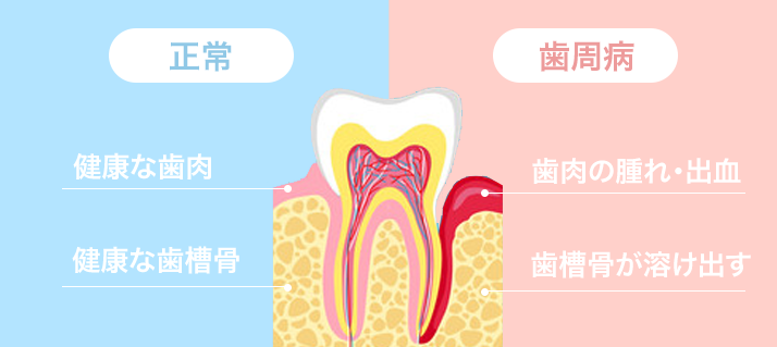 ペリオ(歯周歯)