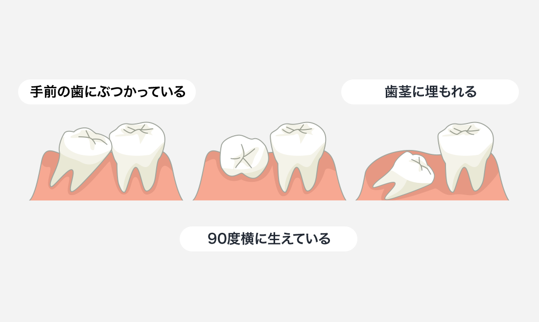 親知らずの抜歯