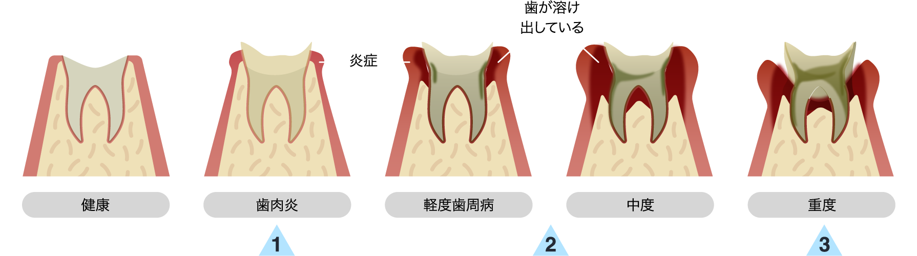 歯周病の進行度