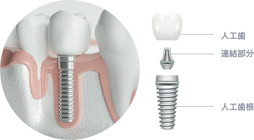インプラント構造を知る